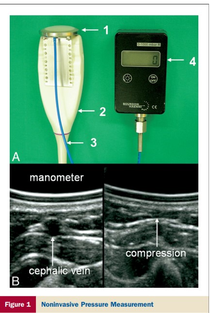 #POCUS 
To measure #CVP noninvasively...
- connect pressure manometer (1) to ultrasound transducer (2)
- compress cephalic vein until collapse (fig B)
- intravasal venous pressure 
on manometer (4) is equal to CVP !!💪

👇 doi.org/10.1016/j.jacc…
Forearm Compression Sonography