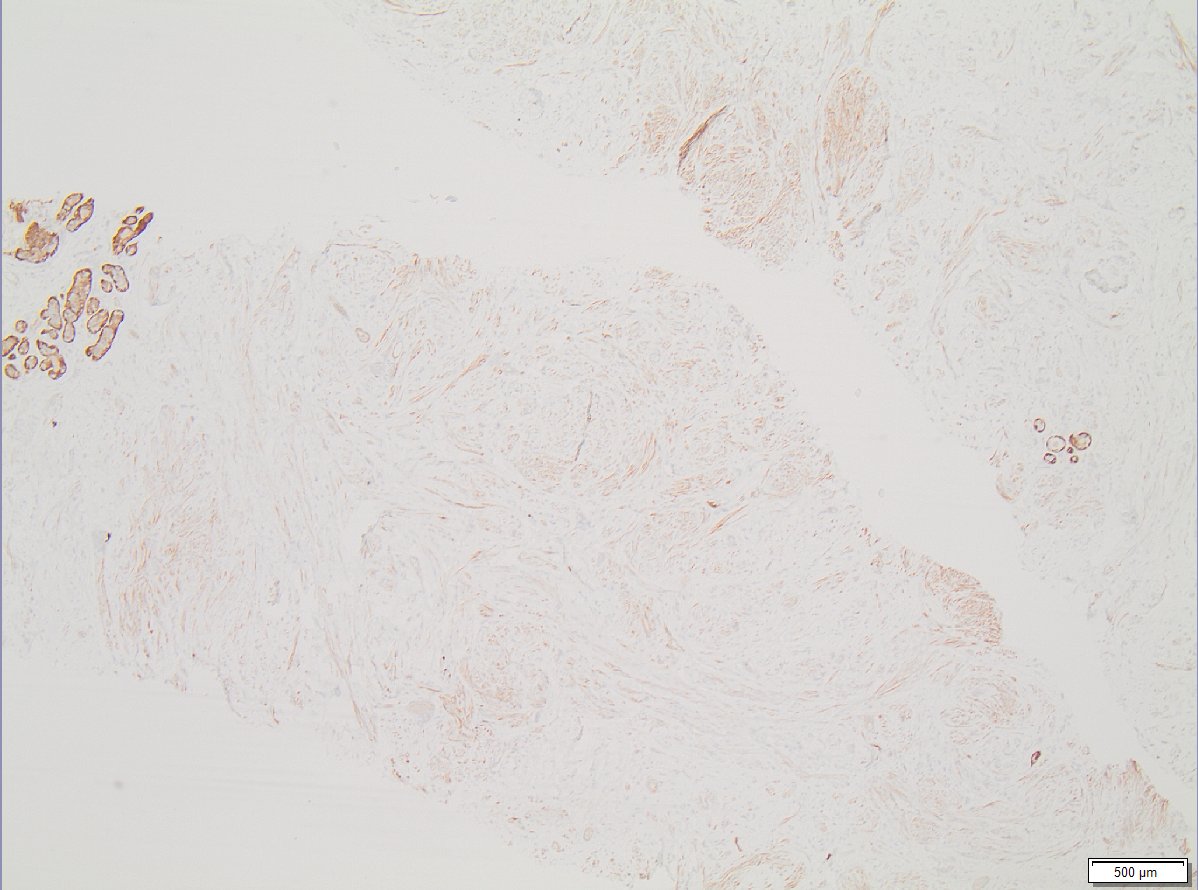 Older female with 6 mm #breastpath mass more than 5 cm away from nipple. Stains= Desmin and S100. Diagnosis?