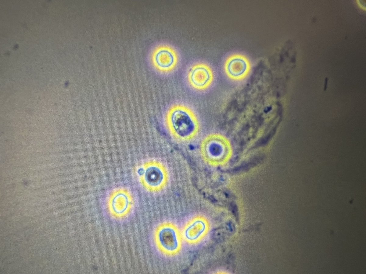 msc271's tweet photo. 52M with PMH HTN, T2DM, HLD, chewing tobacco use, R PCA stroke w/residual peripheral vision loss who presented c/o L-sided hemiparesis, decreased LOC and L-sided twitching and admitted for b/l ACA stroke and AKI on CKD. #UrinarySediment #UrineMicroscopy #acanthocytes https://t.co/eLALbVscIo