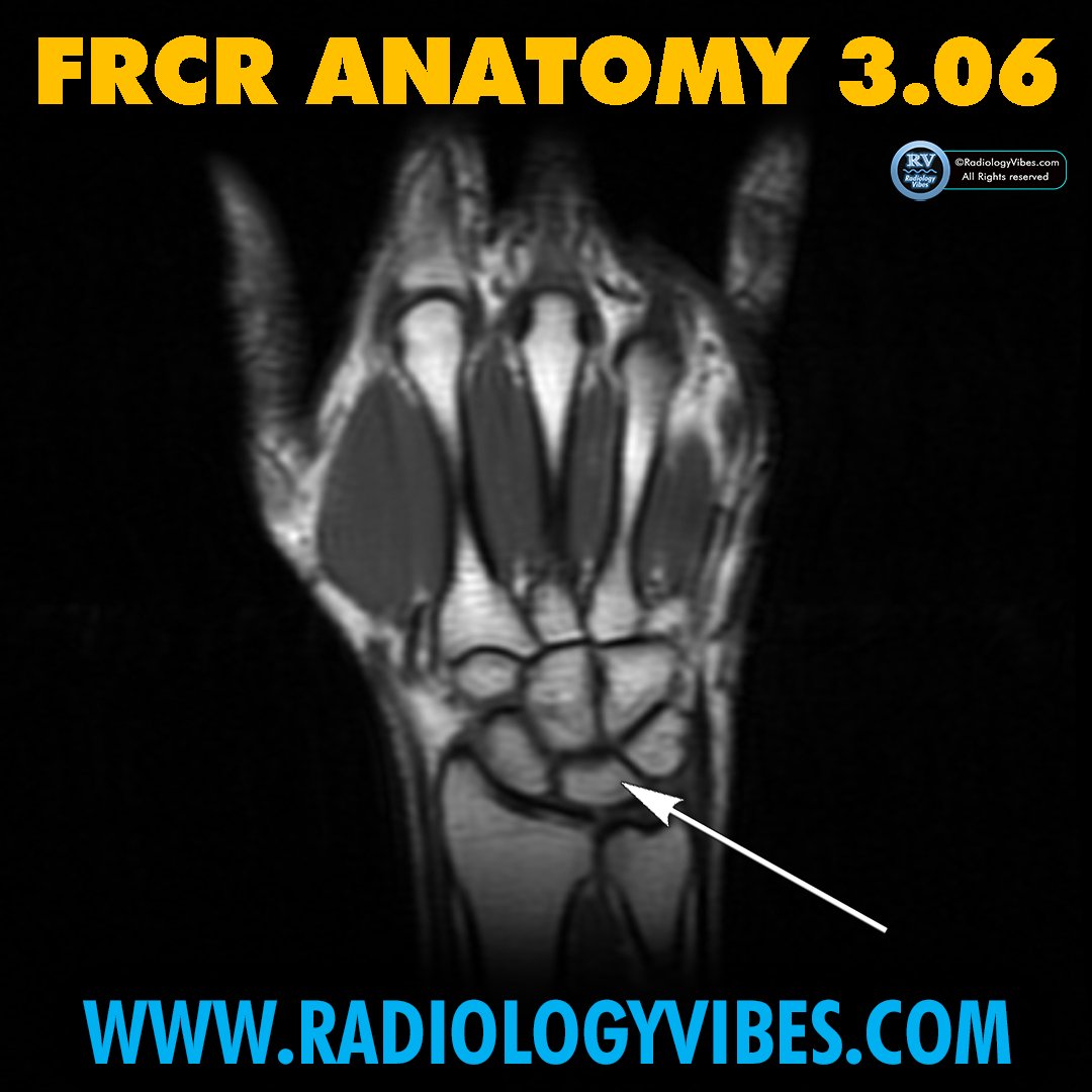 FRCR Anatomy 3.06: Name the arrowed structure

#radres #FOAMrad #FRCR #radiology #anatomy #MedTwitter #radtwitter #FRCRanatomy

@Radiology_Vibes @anatomy4frcr @_the_SRT