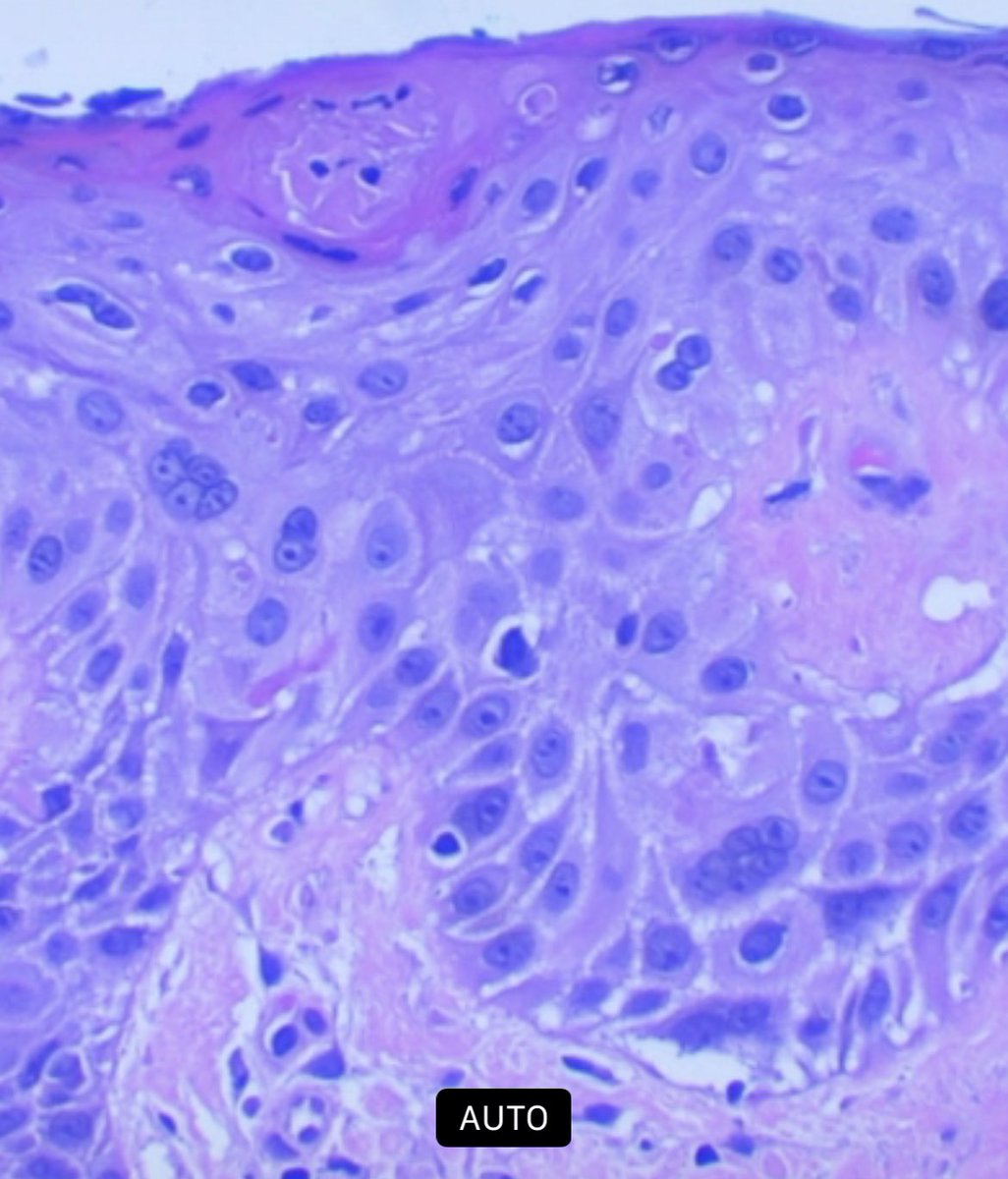 Multinucleated keratinocytes secondary to scratching.

#dermpath #PathTwitter #MedTwitter #dermtwitter