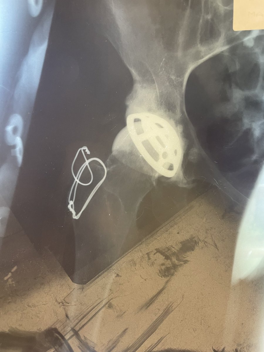 Can anyone tell me what this resurfacing is? I was clearing out the registrars office today and held a couple of old films up to the light. 
Performed through a trochanteric osteotomy. Thoughts? 
#orthotwitter #arthroplasty