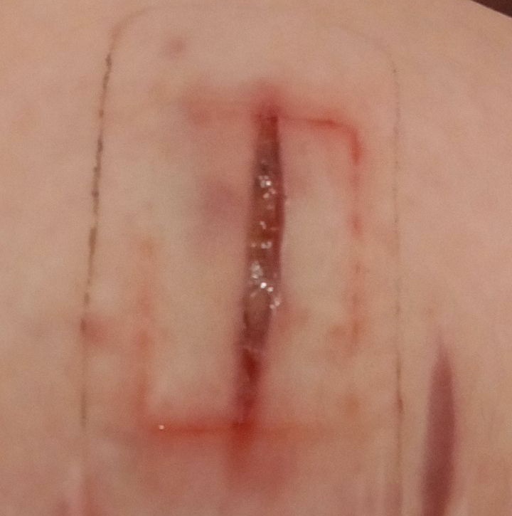 ghostsgrievinhr's tweet photo. Ignore the shit camera quality but the w3lla b4nd4ids b-rned a square into me??? It hurt SO bad. I knew I had reactions to adhesives and b4nd4ids but nothing this bad has ever happened before (I do have bad skin issues so stuff like this isnt the newest but jeez) https://t.co/s3vVwiRQlR