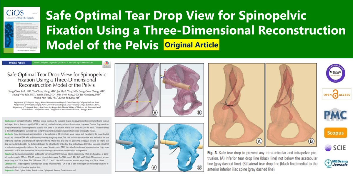 CiOSjournal's tweet image. Safe Optimal Tear Drop View for Spinopelvic Fixation Using a Three-Dimensional Reconstruction Model of the Pelvis
🌷doi.org/10.4055/cios22…
Clin Orthop Surg. 2023 Jun;15(3)Sung Cheol Park
#Pelvis #Spinal_fusion #Tear_drop_view #Spinopelvic_fixation #Three_dimensional