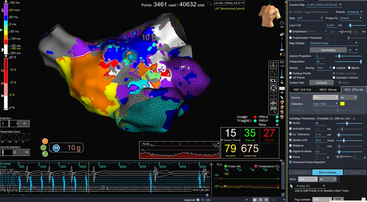 Redo atypical atrial flutter is no match for the signal quality of #TactiFlex, #Omnipolar mapping capability of #HDGrid, and the clarity of #EnsiteX.  This circuit, breaking through a previous anterior line, required a 0.04mV low voltage limit to visualize.  

Love that feeling!
