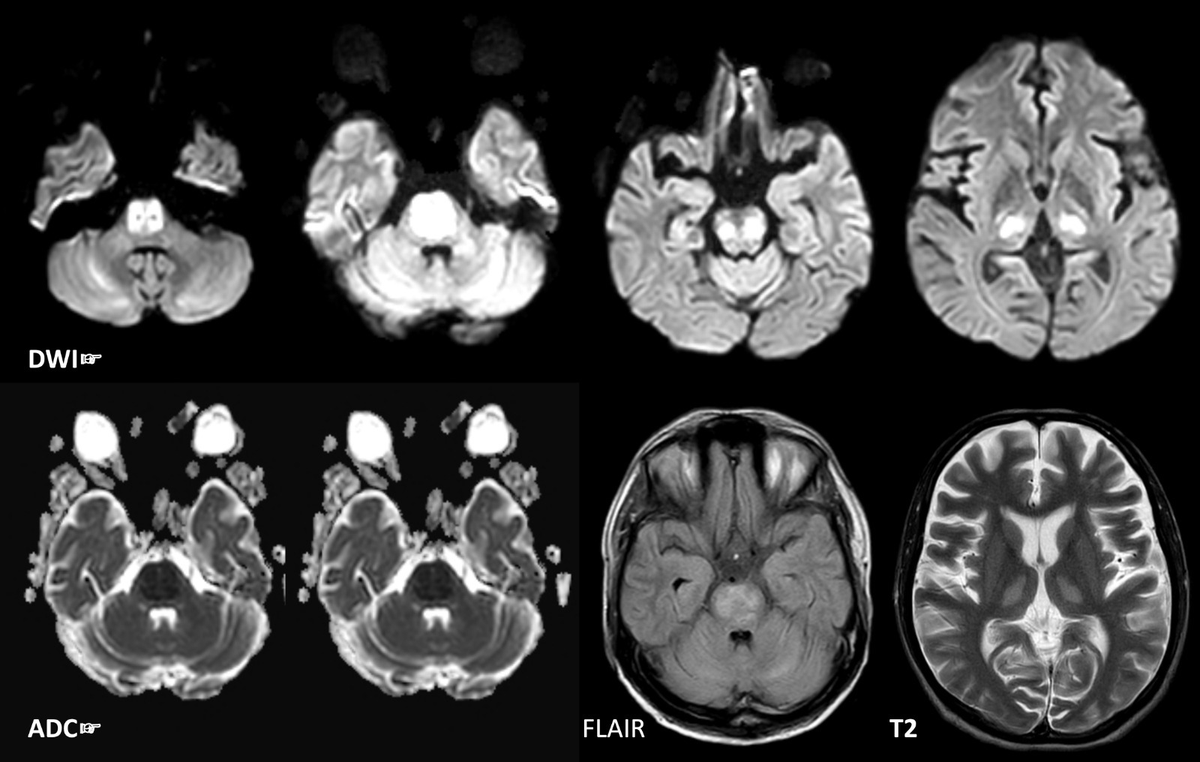 20M. Alcohol ++. P/W  w/ fever, sepsis, ↑ TLC + creatinine, dyselectrolytemia w/ transaminitis on 11.06.2023. Came to us ☞ 7D w/ ↓ sensorium. Na+165. Ventilated, extubated ☞ 3D. Re-ventilated w/in 2D. Neuro consult for quadriparesis (2/5). #MedTwitter #neurotwitter #FOAMrad