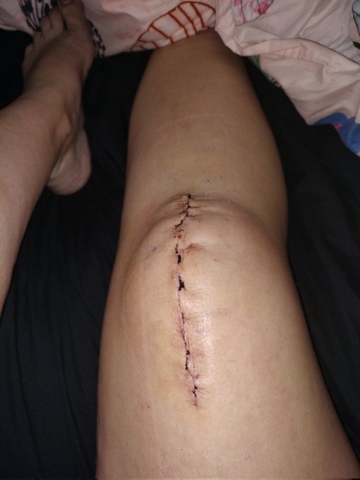 Would not recommend breaking your knee cap 😔 https://t.co/Q4W1S1xw2e