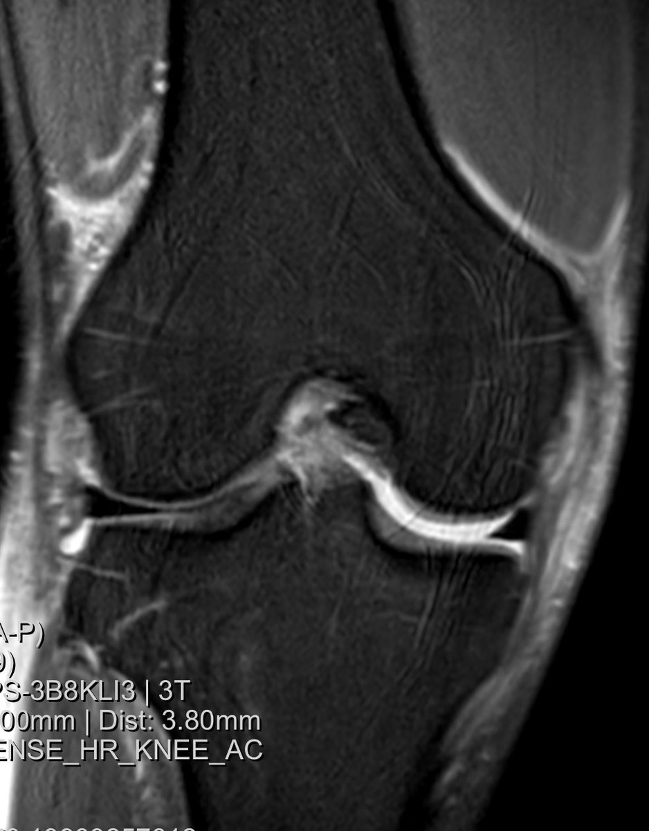 kneepreserve's tweet photo. This is interesting. 37 year old. Basketball injury. Pivot non contact. Acl gone. Look at the medial injury and the medial gapping on mri. Perfect for mcl int brace with Acl recon #mclinternalbrace #allinsideacl https://t.co/8IMmZ4bFpn