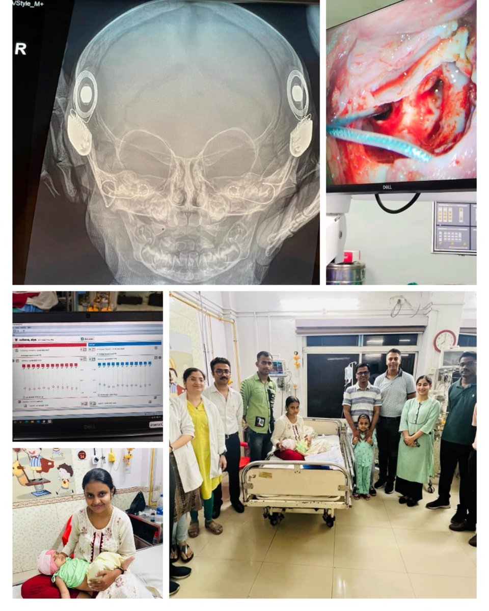 easterncomd's tweet photo. #IndianArmy
Command Hospital (EC) sets a new milestone with simultaneous bilateral cochlear implant surgery in a 7 month old girl child, daughter of serving soldier on 22 Jun 23. This child is youngest reported infant to undergo this advanced surgery in Armed Forces Medical Services and the country by Lt Col Sunil Goyal (CI Surgeon) & Col Indranill Sikdar (Anesthesiologist).
@adgpi
@SpokespersonMoD 

Facebook - https://t.co/fuqgrQEp8E
Instagram - https://t.co/5xxFeOI5yq