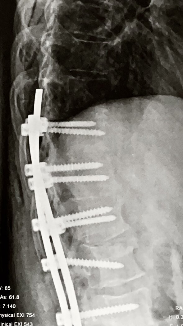 samtnmd's tweet photo. Two weeks post-op. Had my spine fused T10-L4 with @Medtronic titanium screws and rods. https://t.co/ECCCb6X6qD