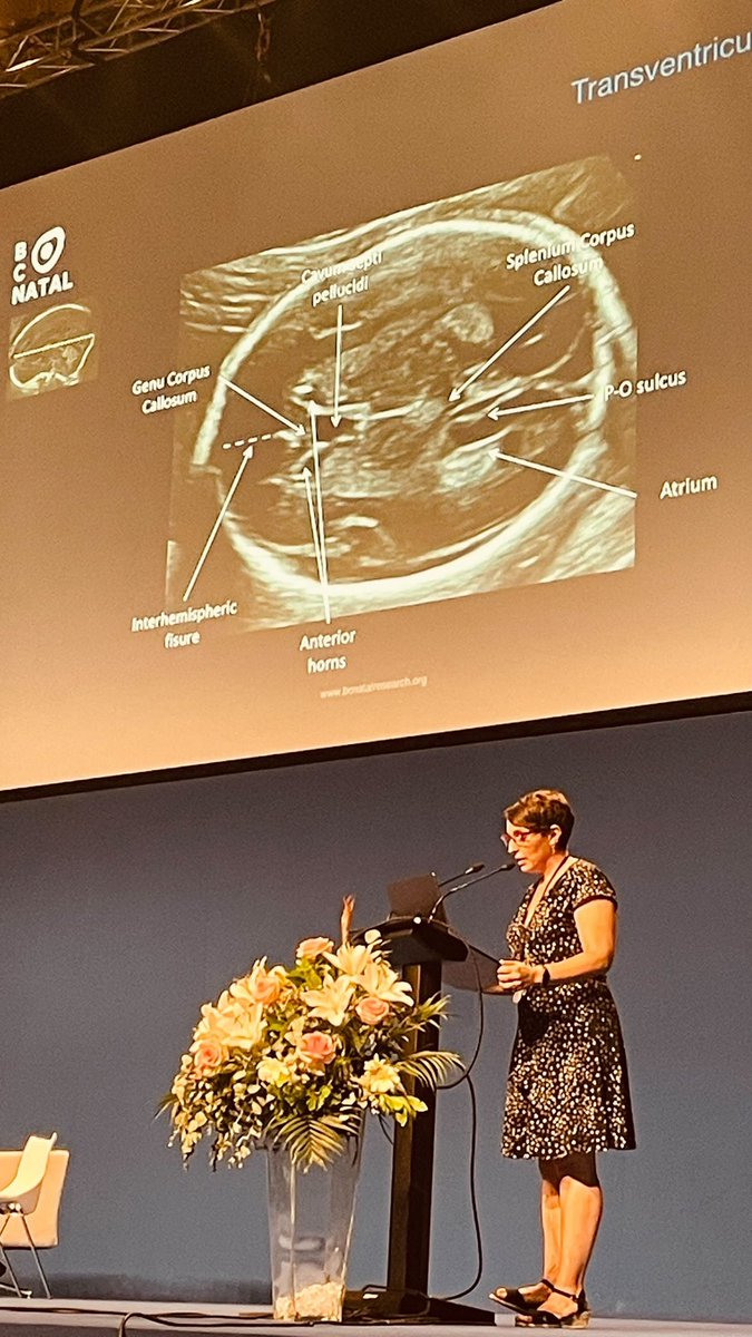 medfetalBCN's tweet photo. Enfoque transabdominal en neurosonografía fetal: “Presta más atención a la apariencia de las estructuras que a sus medidas”, @elisendaeixarch 

🟢 Aprende con ella, este septiembre en nuestro curso de medicina maternofetal en Cartagena!

👇 Inscripciones
https://t.co/SBCYhRw7G3 https://t.co/sBidtkwToo