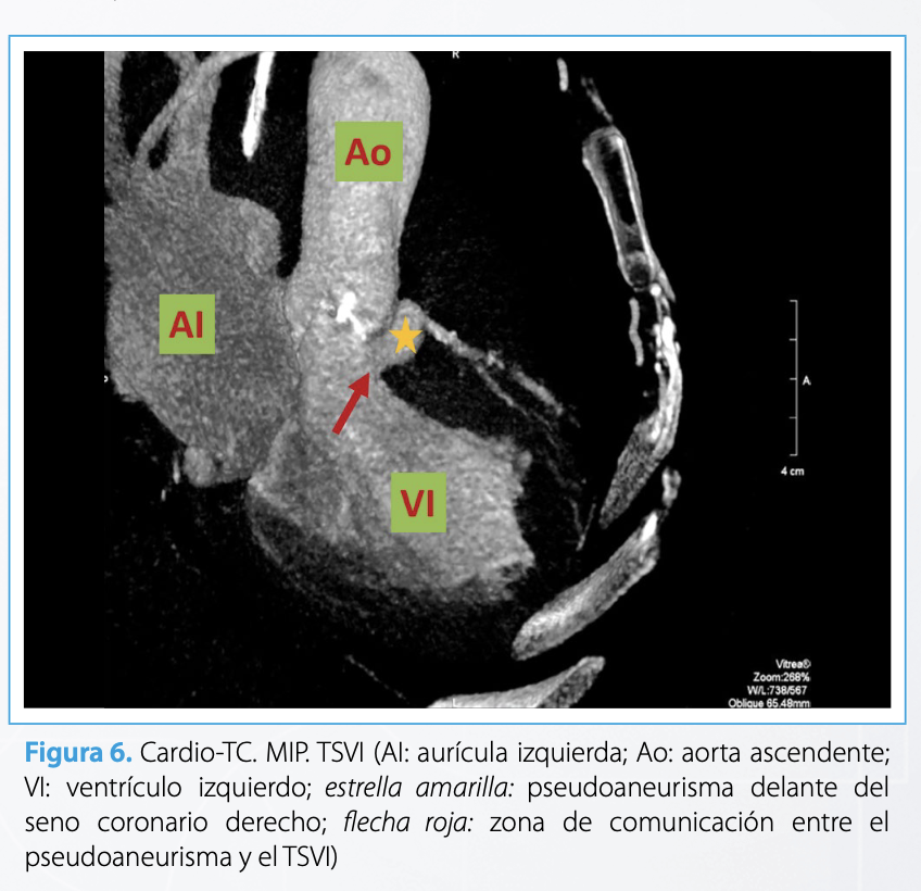 RevistaRetic (@revistaretic) on Twitter photo La fístula aortocavitaria es una entidad rara que ocurre en menos del 2,2% de la endocarditis valvular nativa...
imagenretic.org/RevEcocarPract…
<a href="/almasthela/">Alma Sthela Arrioja, MD</a> <a href="/mariovar55/">Mario Vargas Galgani</a> <a href="/CarlosfrancoEco/">CarlosFranco_ECO</a> <a href="/MAecocardio/">MA Garcia Fernandez</a> <a href="/josejgdnews/">Jose Juan Gomez</a> <a href="/Azcarate_Cardio/">Doctor Pedro Azcárate</a> <a href="/javierurmeneta1/">Javier Urmeneta</a> <a href="/rafavidalperez/">rafavidalperez</a> <a href="/chileanestesia/">Editora Revista Chilena de Anestesia</a> La fístula aortocavitaria es una entidad rara que ocurre en menos del 2,2% de la endocarditis valvular nativa...
imagenretic.org/RevEcocarPract…
<a href="/almasthela/">Alma Sthela Arrioja, MD</a> <a href="/mariovar55/">Mario Vargas Galgani</a> <a href="/CarlosfrancoEco/">CarlosFranco_ECO</a> <a href="/MAecocardio/">MA Garcia Fernandez</a> <a href="/josejgdnews/">Jose Juan Gomez</a> <a href="/Azcarate_Cardio/">Doctor Pedro Azcárate</a> <a href="/javierurmeneta1/">Javier Urmeneta</a> <a href="/rafavidalperez/">rafavidalperez</a> <a href="/chileanestesia/">Editora Revista Chilena de Anestesia</a>