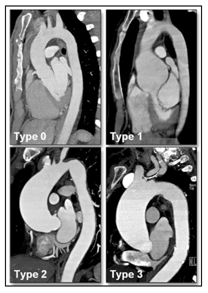 Reviews in Cardiovascular Medicine (@rcmjournal) on Twitter photo #RCM - Vol. 24 No. 6
🏆Review
Implications of Bicuspid Aortic Valve Disease and Aortic Stenosis/Insufficiency as Risk Factors for Thoracic Aortic Aneurysm
📍from <a href="/LaraGharibeh/">Lara Gharibeh, PhD</a>, @EstiCastillero, <a href="/ferrag02/">Giovanni Ferrari PhD</a>, <a href="/HirooTakayamaMD/">Hiroo Takayama</a>, Juan B. Grau et al.
#BAV #TAA
🔓
imrpress.com/journal/RCM/24… #RCM - Vol. 24 No. 6
🏆Review
Implications of Bicuspid Aortic Valve Disease and Aortic Stenosis/Insufficiency as Risk Factors for Thoracic Aortic Aneurysm
📍from <a href="/LaraGharibeh/">Lara Gharibeh, PhD</a>, @EstiCastillero, <a href="/ferrag02/">Giovanni Ferrari PhD</a>, <a href="/HirooTakayamaMD/">Hiroo Takayama</a>, Juan B. Grau et al.
#BAV #TAA
🔓
imrpress.com/journal/RCM/24…