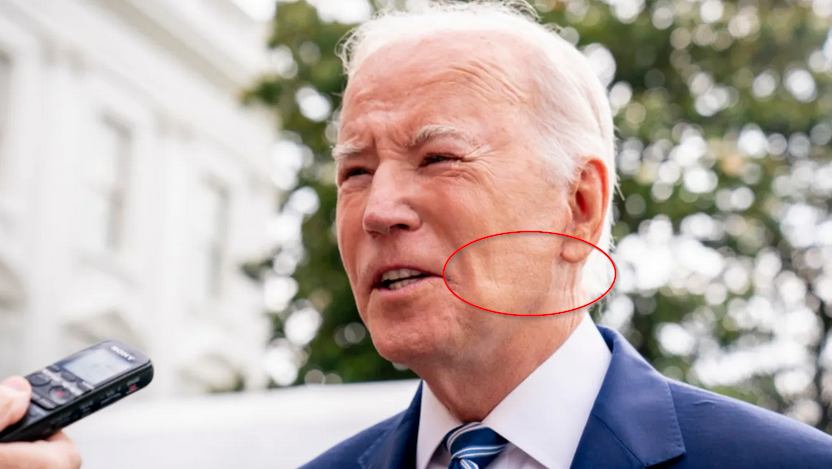BobbyFreedom1's tweet photo. Correct me if I'm wrong if you have sleep apnea you use a cpap machine when you sleep. So unless @joebiden sleeps in his suits and sleep in the oval office the odds of him having those marks on his face from a cpap machine is a load of crap. https://t.co/sJiyWpp8ma