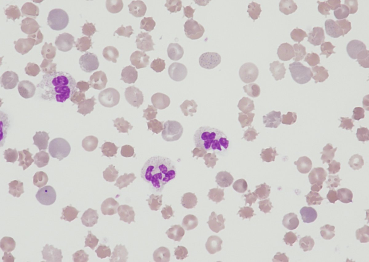 Promyelocyte13's tweet photo. This morning's #bitesizemorphology #haematology @UHNM_NHS #NMCPS we've looked at 3 #ALD cases including #zievessyndrome & one with beautiful #targetcells 30 mins of #education #training across our #pathologynetwork #haemteam discussing pathophysiology & expected results π¬π©βπ¬ https://t.co/4flMIAU8bs