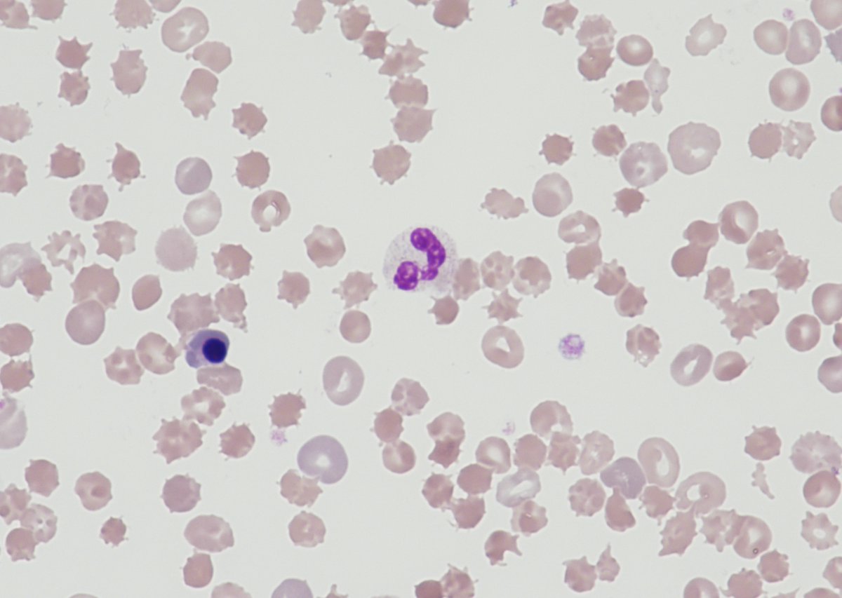 Promyelocyte13's tweet photo. This morning's #bitesizemorphology #haematology @UHNM_NHS #NMCPS we've looked at 3 #ALD cases including #zievessyndrome & one with beautiful #targetcells 30 mins of #education #training across our #pathologynetwork #haemteam discussing pathophysiology & expected results π¬π©βπ¬ https://t.co/4flMIAU8bs