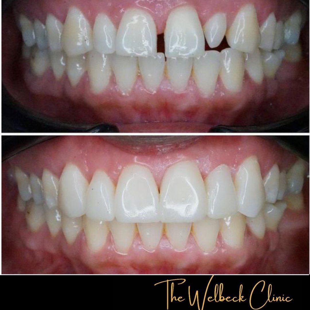 Dr Jahany placed layered composite bonding on the upper 6 front teeth to complete this natural-looking smile makeover. 
To book a consultation contact us on 0207 486 8100
#teeth #smile #composite #bonding #white #smilemakeover #compositebonding #natural #dentist #cosmeticdentist
