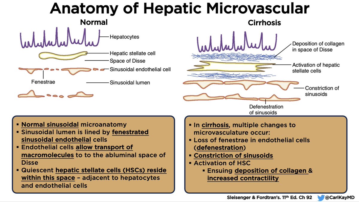 Anatomy of Hepatic Microvasculature

▪️Normal vs Cirrhosis 
▪️Note: 3 major changes 
   1️⃣ Defenestration
   2️⃣ Constriction of sinusoids
   3️⃣ Activation of stellate cells
▪️Microvascular is key to portal HTN
▪️Important in understanding ascites

#LiverTwitter 👊