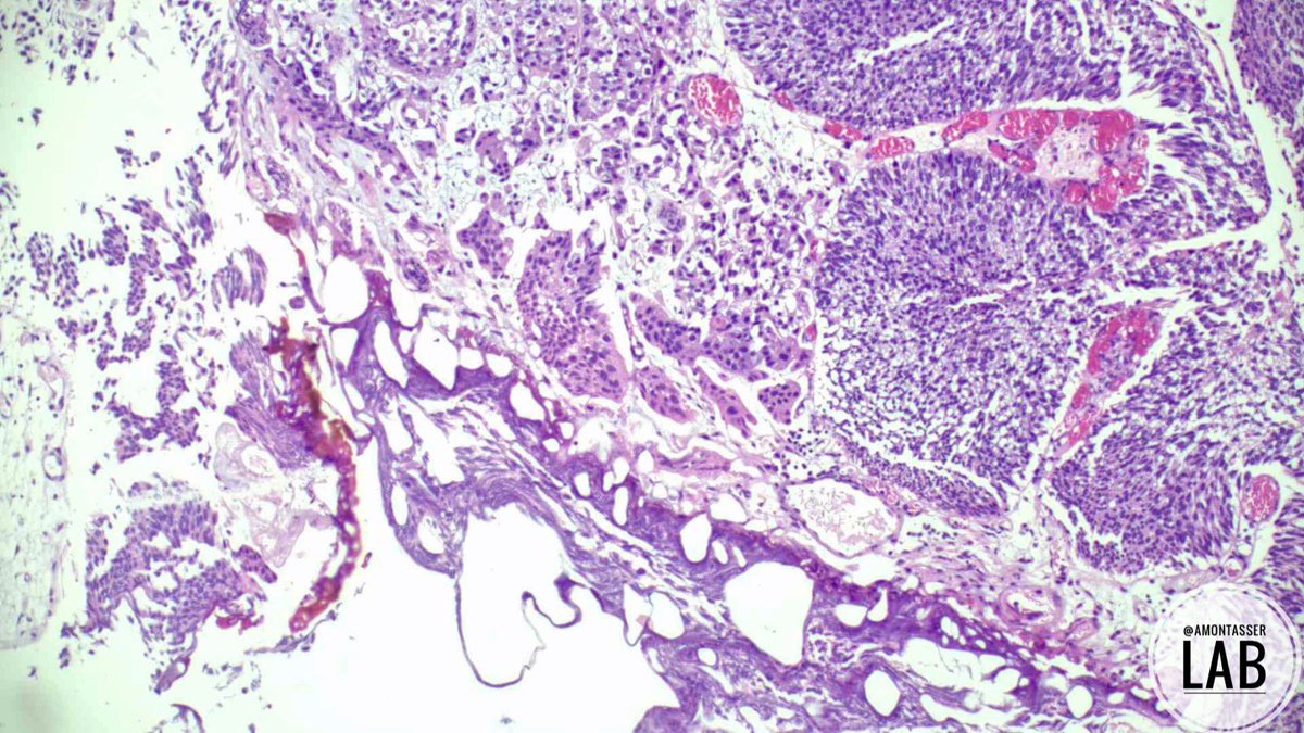 Paradoxical differentiation in HGUC👌🏽

#GUpath #Pathology #PathTwitter