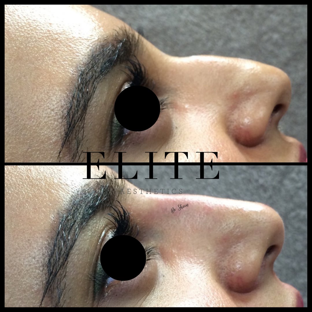 Non-surgical rhinoplasty is a simple effective way to improve the appearance of your nose.
#aesthetics #eliteaesthetics #drshirin #drshirinrecommends #aesthetictreatment #patientresults #beforeandafter #rhinoplasty #nonsurgicalnosejob#Greenhithe #aestheticdoctors