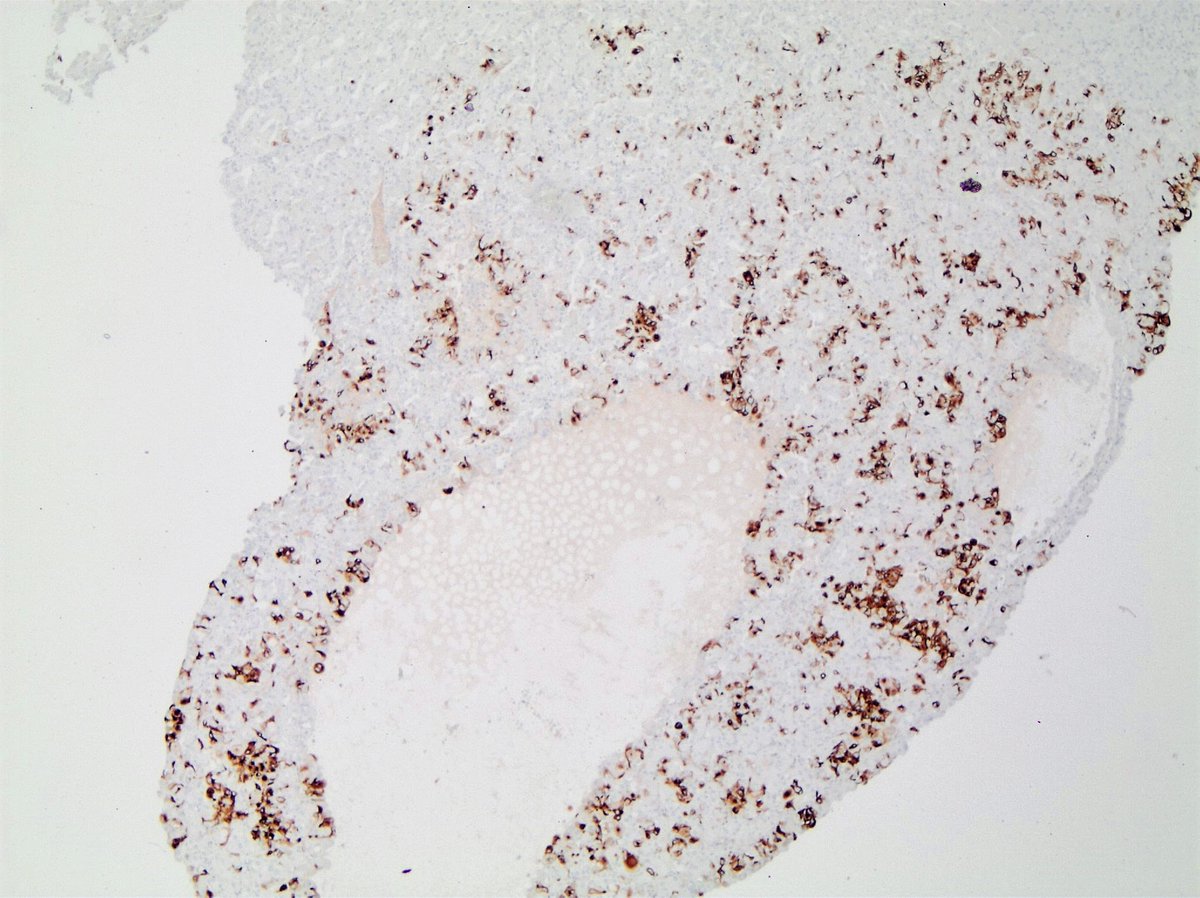ESC-RCC 

 🔪 well-circumscribed, solid-cystic, organ confined
🔬voluminous eosinophilic cytoplasm, coarse basophilic stippling
🗝️KRT20 diffuse or focal +👇
🔗Sporadic, somatic mutations TSC1/TSC2 or in association with Tuberous sclerosis
🫂 mostly pT1 

#GuPath #PinkRenalTumors