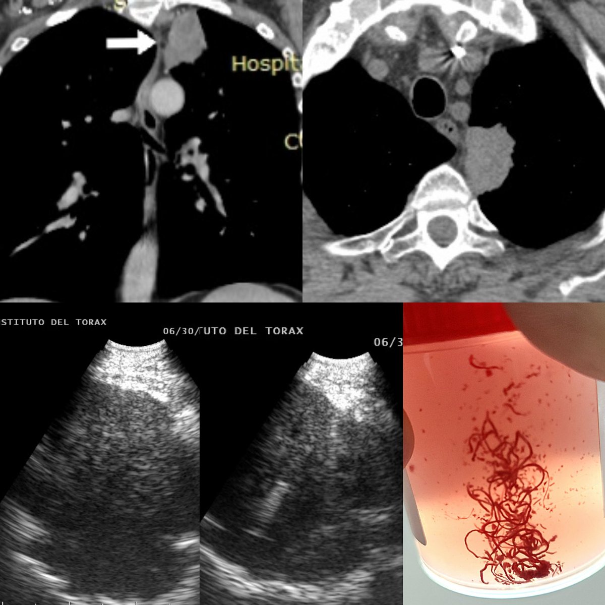 Left paraesophageal tumor.
#lungtumor #lungcancer
EUS-B-NA
22G 
#interventionalpulmonology