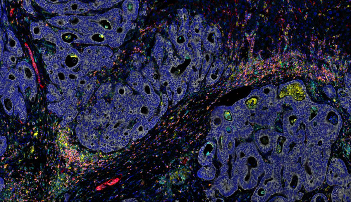BTA_Birmingham's tweet photo. Our latest #BTAImagingHighlight! #6plex staining of colorectal liver metastasis using the #PhenoImager @AkoyaBio https://t.co/dT7BTOJ4Tw