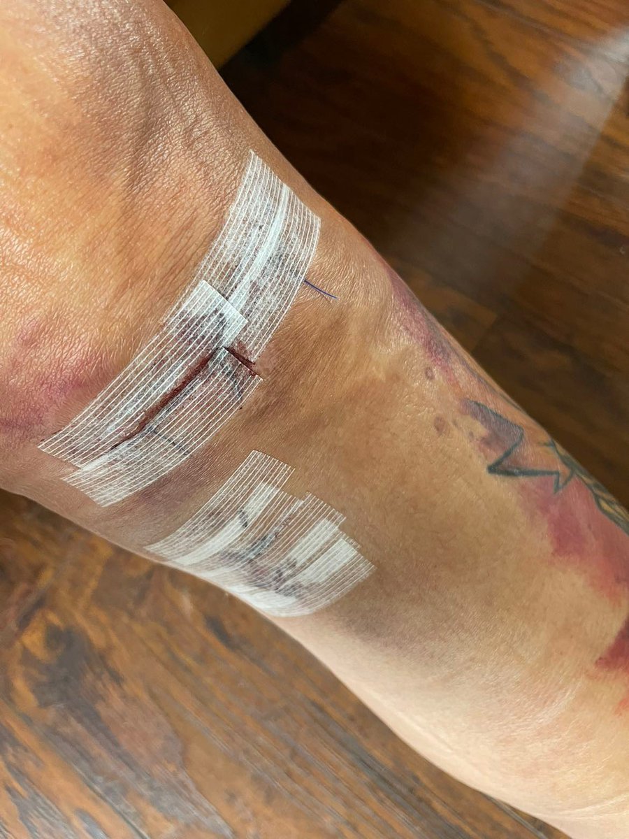 mizuho1901's tweet photo. Today marks 6 months since my #tornmeniscus #ACLsurgery it’s been long and tedious but we’re getting there.. can’t wait to get back into kicking some things and people 😂 #neverskipyourlegdays @XP_Nightingale @ShyGaladriel @morticia_mo https://t.co/uHmveUWgpw