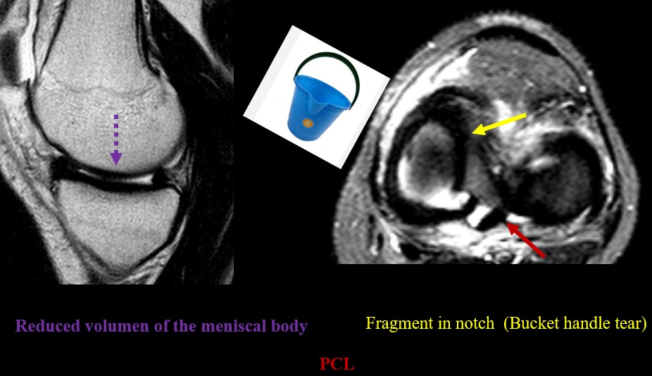 CIC0826's tweet photo. π§π§πͺ£Bucket-handle meniscal tear with double PCL sign
#knee #meniscaltear #classicsign https://t.co/cEEnHNWuuV