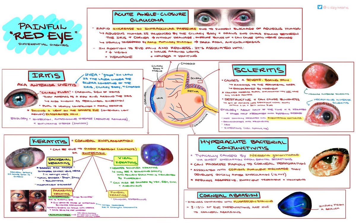 Medical_MD1's tweet photo. Great Review✨

Red Eye 👁️ 

Painful vs painless
. https://t.co/1sl5eoyJYz