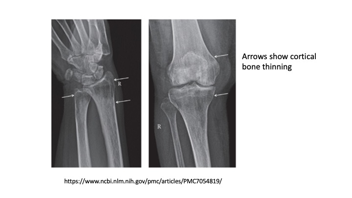 Hyperparathyroidism can lead to the removal of calcium from bones, causing osteoporosis over time. If you have been diagnosed with hyperparathyroidism, a dual energy x-ray absorptiometry (DXA) bone density scan may be helpful to assess your risk of fracture.