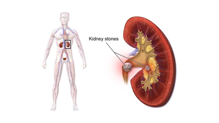 Kidney stones, a complication of hyperparathyroidism, occur due to the increased calcium in the urine. High levels of calcium in the urine can form crystals that eventually grow into stones. These stones can cause severe pain and may require medical intervention for removal
