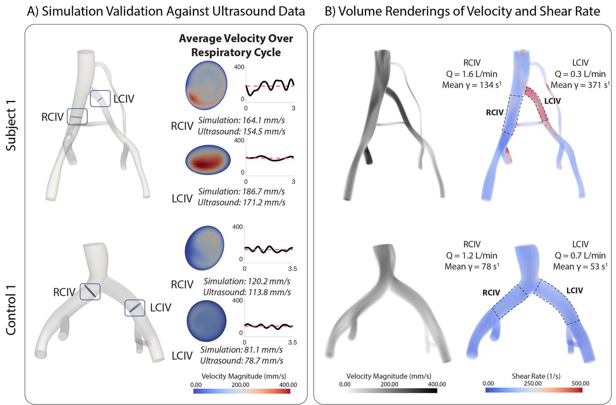 C. Alberto Figueroa (@bloodflowsim) on Twitter photo Congrats to @IsmaelAssi1 on his first ever pub: an #ultrasound & #CFD protocol to assess iliac vein hemodynamics!
Thanks to <a href="/sabrinarlynch/">Sabrina Lynch, PhD</a> <a href="/AndreaObiMD/">Andrea Obi MD</a> <a href="/thomaswakefield/">Thomas Wakefield</a> ๐๐๐ฏ๐ ๐๐ข๐ฅ๐ฅ๐ข๐๐ฆ๐ฌ & ๐. ๐๐๐ฆ๐ฎ๐ฅ๐๐ค
sciencedirect.com/science/articlโฆ
<a href="/UoMVascSurgery/">UoM Vascular Surgery</a> <a href="/UMBME/">U-M BME</a> <a href="/umichCVC/">U-M Health Frankel CVC</a> Congrats to @IsmaelAssi1 on his first ever pub: an #ultrasound & #CFD protocol to assess iliac vein hemodynamics!
Thanks to <a href="/sabrinarlynch/">Sabrina Lynch, PhD</a> <a href="/AndreaObiMD/">Andrea Obi MD</a> <a href="/thomaswakefield/">Thomas Wakefield</a> ๐๐๐ฏ๐ ๐๐ข๐ฅ๐ฅ๐ข๐๐ฆ๐ฌ & ๐. ๐๐๐ฆ๐ฎ๐ฅ๐๐ค
sciencedirect.com/science/articlโฆ
<a href="/UoMVascSurgery/">UoM Vascular Surgery</a> <a href="/UMBME/">U-M BME</a> <a href="/umichCVC/">U-M Health Frankel CVC</a>