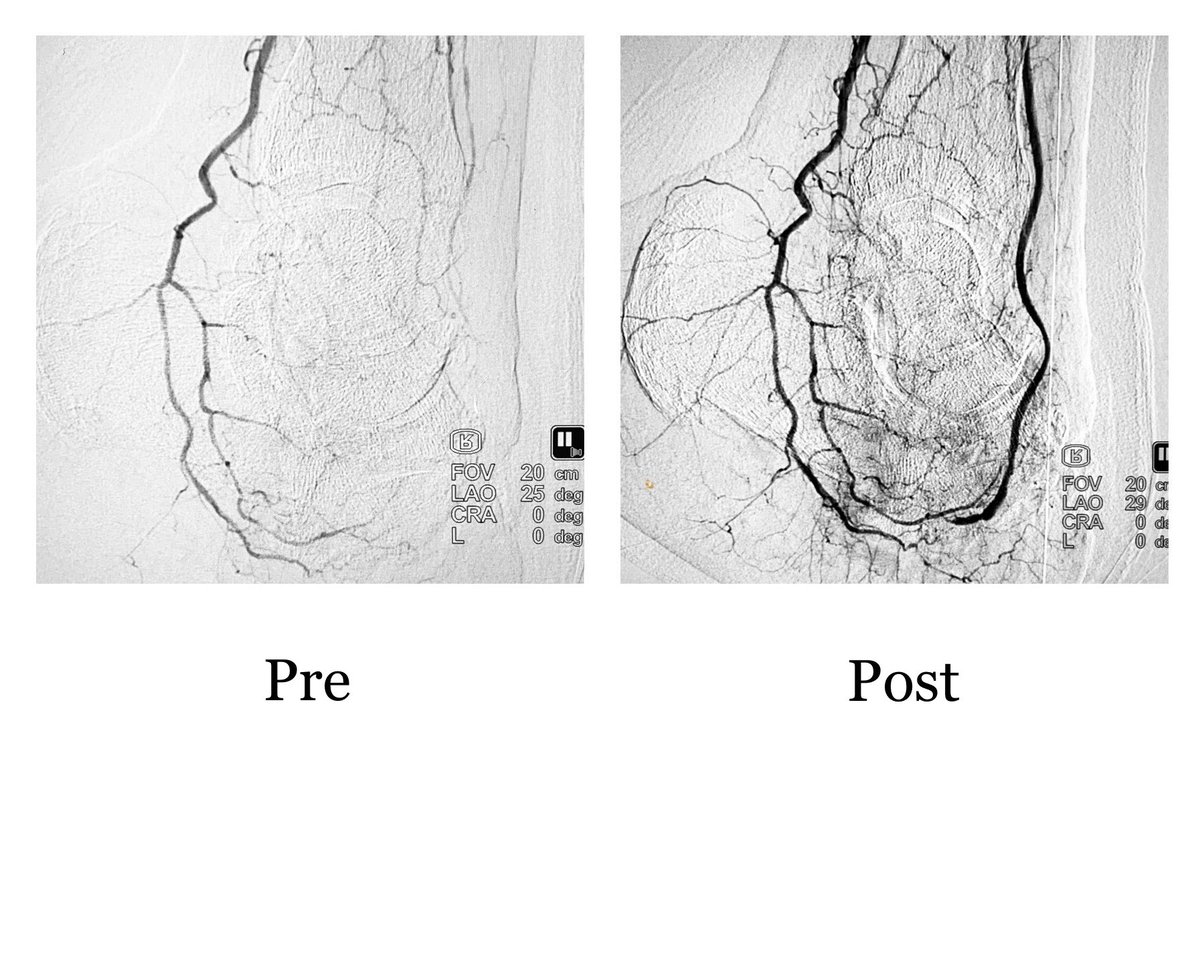 62M,DM+,CTLI, Rutherford 6, prev forefoot amputation, non healing wound
.
SFA stentosis + long seg ATA occlusion
.
SFA stenting (6x40) + ATA plasty (2.5 x 220) done
.
#irad #MedEd #MedTwitter #CardioTwitter #radres #foamrad @SIRRFS @SIRspecialists @SIR_ECS @_backtable @ISVIRIndia