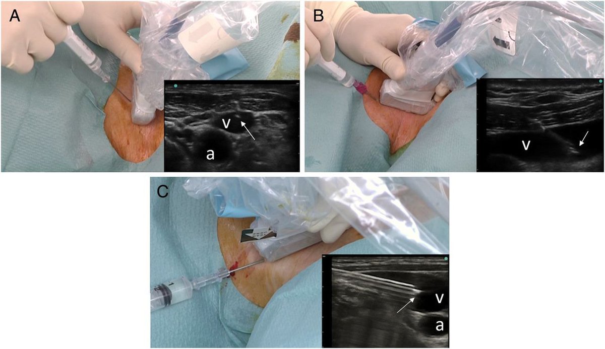 Randomized comparison of three transducer orientation approaches for #POCUS guided internal jugular venous cannulation, short-axis, long-axis and oblique-axis
#MedEd #FOAMcc 
🔗pubmed.ncbi.nlm.nih.gov/26705350/
Expert input/comments welcome👩‍⚕️👨‍⚕️