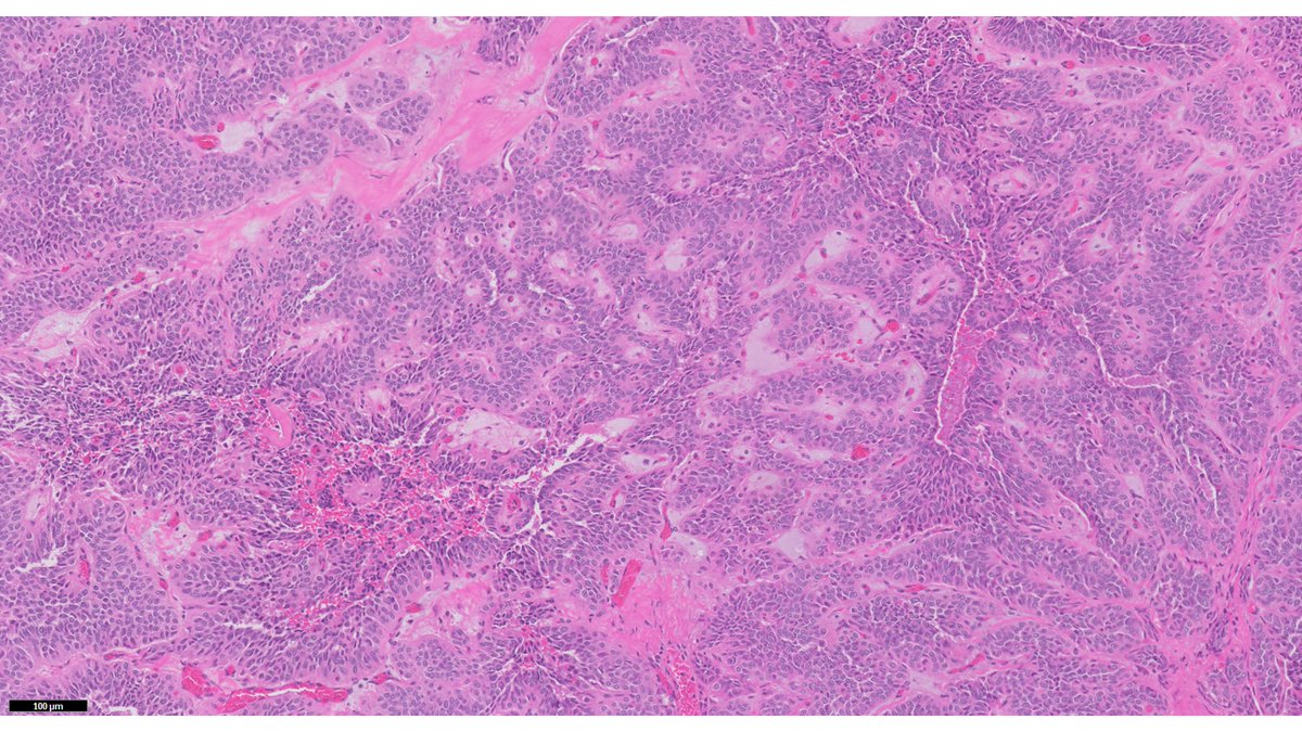 TomHaPath's tweet image. Mass in Pancreas, most likely patient demographics?
#Path #Pathology #PathTwitter #GIPath #GI