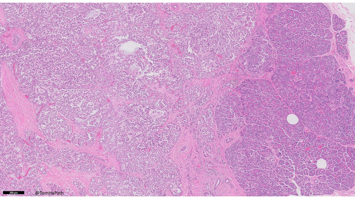 TomHaPath's tweet image. Mass in Pancreas, most likely patient demographics?
#Path #Pathology #PathTwitter #GIPath #GI