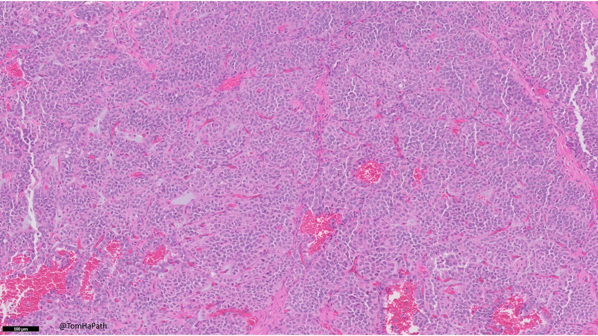 TomHaPath's tweet image. Mass in Pancreas, most likely patient demographics?
#Path #Pathology #PathTwitter #GIPath #GI