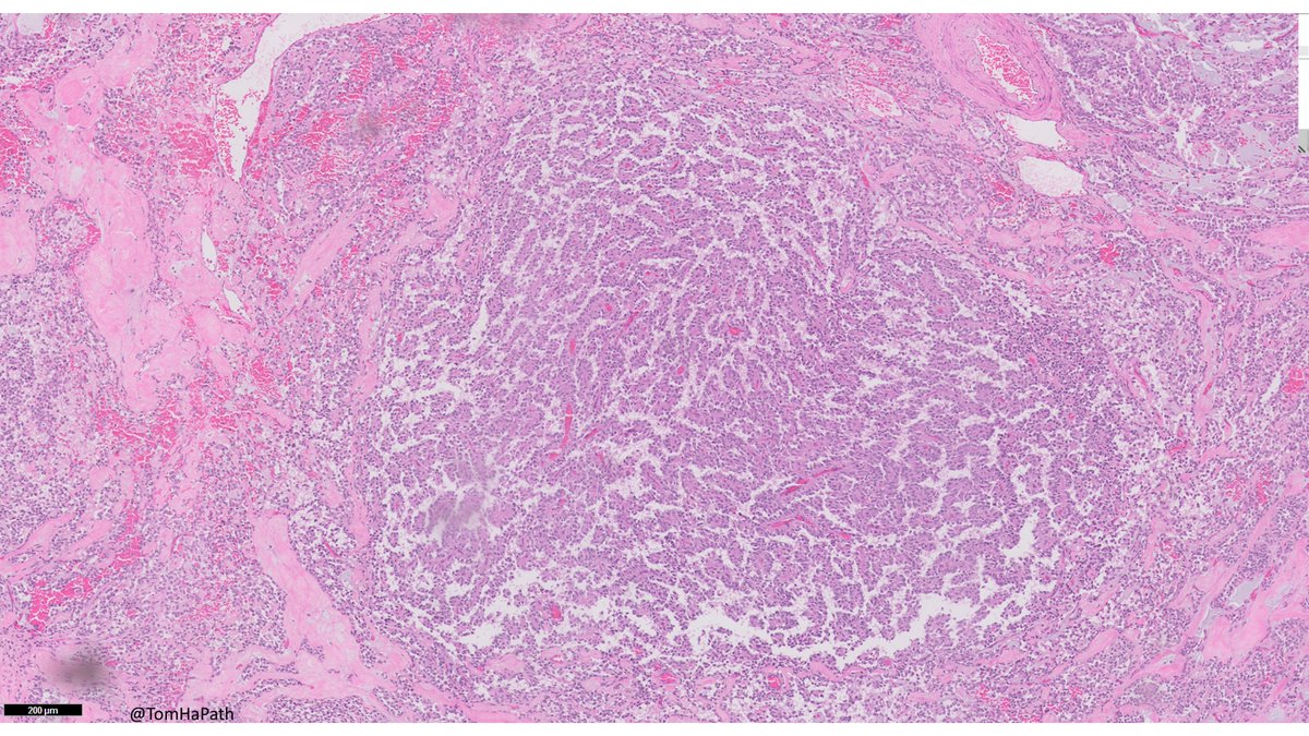 TomHaPath's tweet image. Mass in Pancreas, most likely patient demographics?
#Path #Pathology #PathTwitter #GIPath #GI