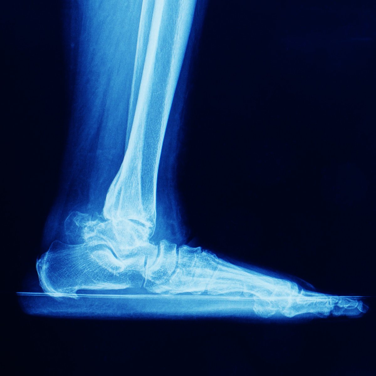 FASO offers diagnosis and treatment for a wide range of orthopedic injuries and conditions, including ankle arthritis. 

With proper treatment, many people with ankle arthritis are able to managepain and continue leading an active lifestyle. 

Call us at (405) 418-4500.
