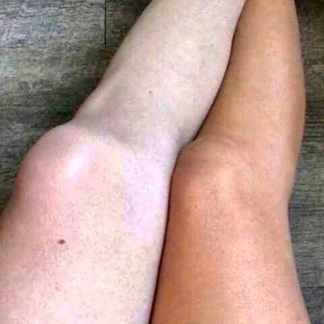 nancyw2810's tweet image. Self tanners are great during the summer for that quick, bronzed glow without sun damage! But please come self tanner and fragrance free to your #lymphaticmassage appointments! 🙂💕