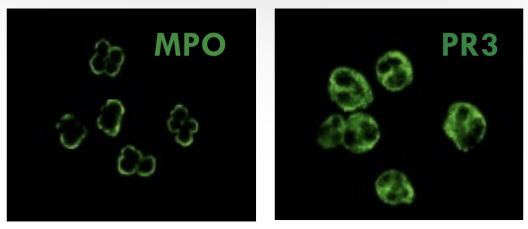 Seuls les ANCA (anticorps anti-cytoplasme des PNN) dirigés contre la protéinase 3 (PR3) ou la myeloperoxydase (MPO) ont un intérêt pour le diagnostic de vascularite à ANCA. Les ANCA sans spécificité n’ont pas d’intérêt  diagnostique +++ #ANCA #VAA #GFEV