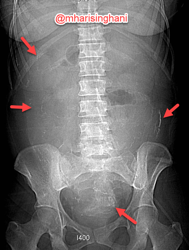 Encapsulating peritoneal sclerosis  in chronic renal failure