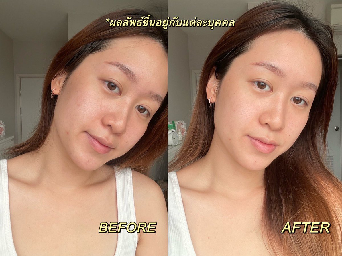 proudSRn's tweet photo. หลังกลับจากทะเล ผิวหมองมาก รอยสิวขึ้นเต็มเลย เลยลองมาใช้  Vitamin C Green Tea Enzyme Brightening Serum ประมาณ3-4วัน รอยสิวลดลง ผิวไบร์ทขึ้น เพราะมีส่วนผสมสกัดเอนไซม์จากชาเขียว #เดบิวต์ผิวไบร์ท #INNISFREEVitaC #innisfreethailand

Reply 
พิกัด : shopee / lazada / innisfree shop https://t.co/4zEQc0Wiem