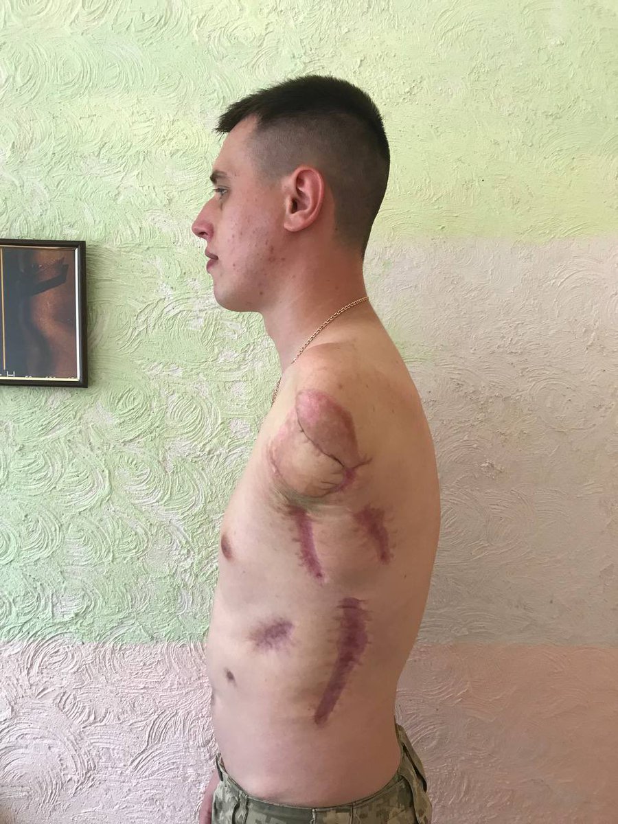 vlad_beseda's tweet photo. ‼️МАКСИМАЛЬНЕ ПОШИРЕННЯ ДРУЗІ‼️

Друзі продовжуємо збір на моє протезування.

Не забувайте підписуватись на мене. У себе на сторінці буду розповідати про протезування.

Залишилось зібрати 560 000 гривень.
Всім дякую хто долучається до збору.🦾

Реквізити: 
https://t.co/q0N0fFohpm https://t.co/AwTs5xGF9S