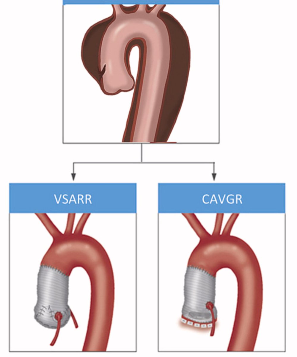 M_Pompeu_Sa_MD's tweet photo. 🔥Hot off the press🔥 Read our paper in @IJCardio: VSARR vs Bentall in type A #AorticDissection https://t.co/FMutkRHAAL

@TasoudisPanos @XanderJacquemyn @JefVandenEynde @AArjomandiRad @AWeymannMD @ruhparwar #Chu #SernaGallegos @IbrahimSultanMD 

@HviUpmc @UPMC_CTSurgery 
#AortaEd https://t.co/bobNkiDqIN