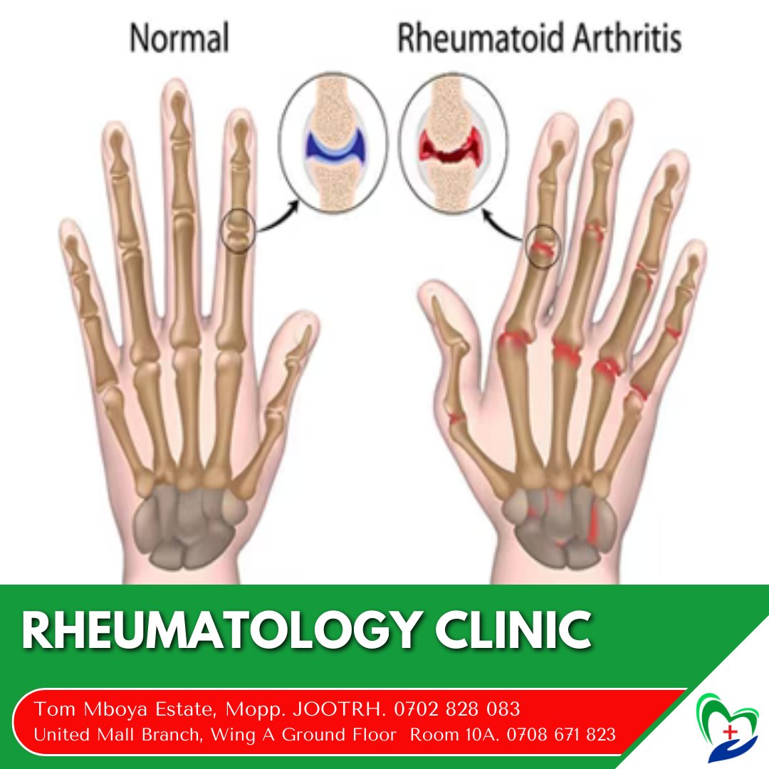 We diagnose and provide care for 🩺:
•Osteoarthritis (OA).
•Rheumatoid Arthritis (RA)
•Lupus.
•Spondyloarthropathies - ankylosing spondylitis (AS) and psoriatic arthritis (PsA)
•Sjogren's Syndrome.
•Gout.
•Scleroderma.
•Infectious Arthritis.