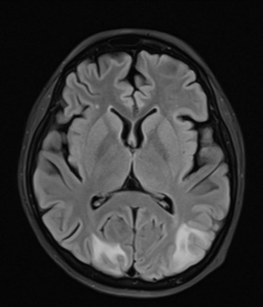16 year old f with hx of lupus nephritis presented with headaches, altered mental status, and focal neurological deficits. BP: 180/90. What is the likely diagnosis? (Image Radiopaedia.org, case by Zilma Carolina Perez Peña) #FOAMrad #medtwitter