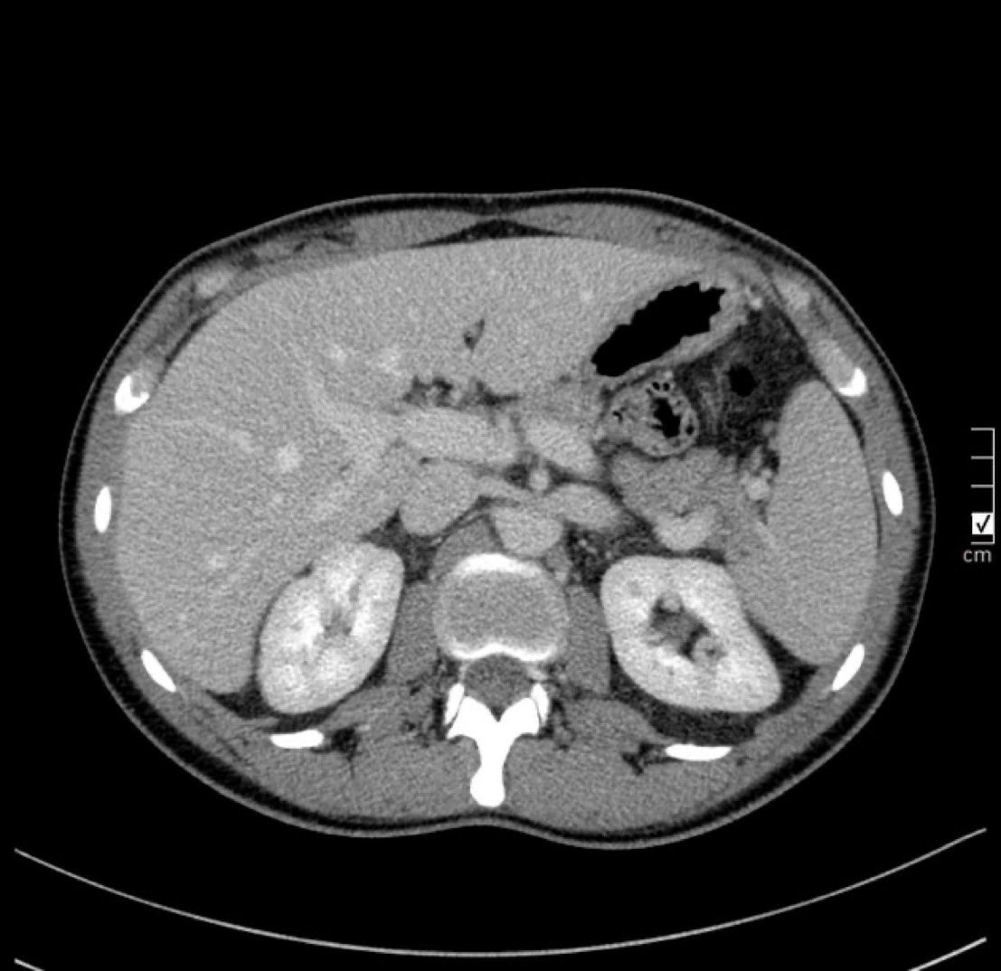 A 35 year old man presented with chronic left hypochondrial pain and intermittent hematuria. What is the likely diagnosis? (Image @Radiopaedia, case by Sigmund stuppner) #FOAMed