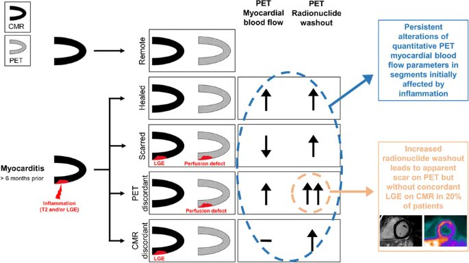 buechelrr's tweet photo. Long-term sequelae after myocarditis. Is "healed" myocardium really restored ad integrum? #thinkPET suggests otherwise. What do you think? Read our latest research at EJNMMI. https://t.co/igDZ494nvz. #thinkPET #yesCMR @domcbenz @andgiannopmd @rmanka_ @BettinaHeideck1 https://t.co/ROJa6ph7ME